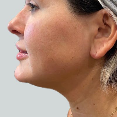 Morpheus8 Gallery Before & After Gallery - Patient 149096605 - Image 1