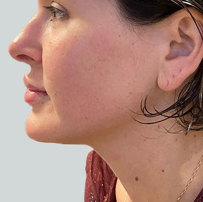 Morpheus8 Gallery Before & After Gallery - Patient 149096605 - Image 2