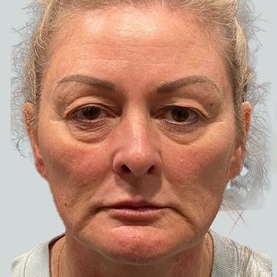 Morpheus8 Gallery Before & After Gallery - Patient 149096683 - Image 1