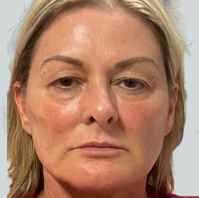 Morpheus8 Gallery Before & After Gallery - Patient 149096683 - Image 2