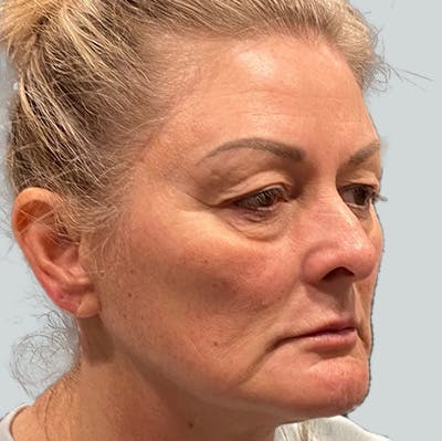 Morpheus8 Gallery Before & After Gallery - Patient 149096684 - Image 1