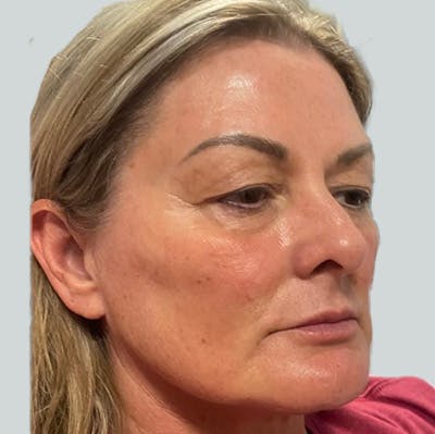 Morpheus8 Gallery Before & After Gallery - Patient 149096684 - Image 2