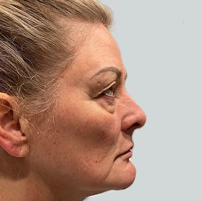 Morpheus8 Gallery Before & After Gallery - Patient 149096685 - Image 1
