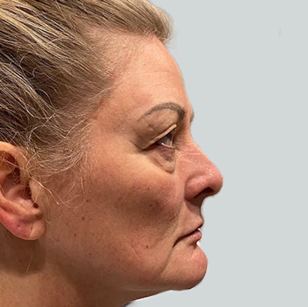 Morpheus8 Before & After Gallery - Patient 149096685 - Image 1