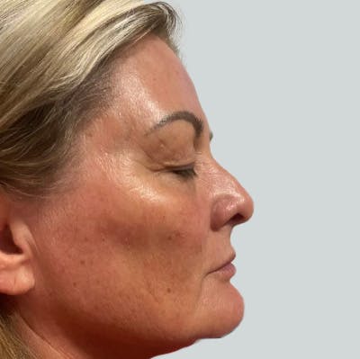 Morpheus8 Gallery Before & After Gallery - Patient 149096685 - Image 2