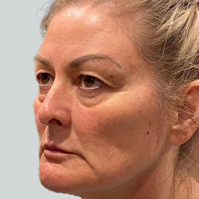 Morpheus8 Gallery Before & After Gallery - Patient 149096686 - Image 1