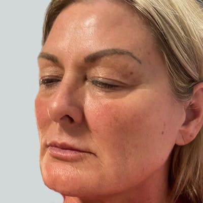 Morpheus8 Gallery Before & After Gallery - Patient 149096686 - Image 2