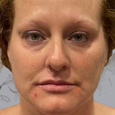 Morpheus8 Gallery Before & After Gallery - Patient 164689286 - Image 1