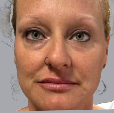 Morpheus8 Gallery Before & After Gallery - Patient 164689286 - Image 2