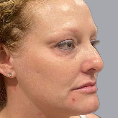 Morpheus8 Gallery Before & After Gallery - Patient 164689285 - Image 1