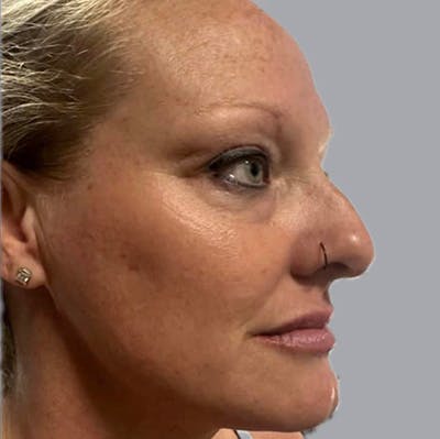 Morpheus8 Gallery Before & After Gallery - Patient 164689285 - Image 2