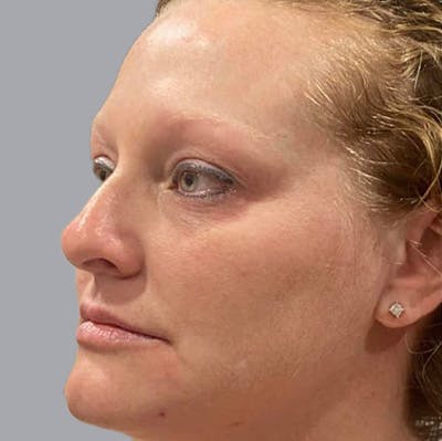Morpheus8 Gallery Before & After Gallery - Patient 164689284 - Image 1
