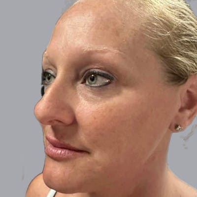 Morpheus8 Gallery Before & After Gallery - Patient 164689284 - Image 2