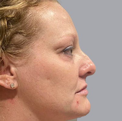 Morpheus8 Gallery Before & After Gallery - Patient 164689296 - Image 1