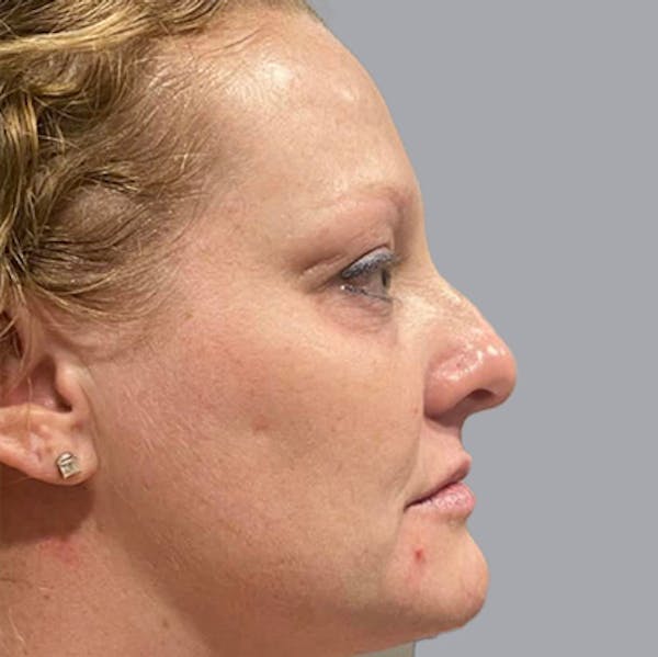 Morpheus8 Gallery Before & After Gallery - Patient 164689296 - Image 1