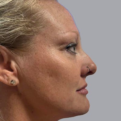 Morpheus8 Gallery Before & After Gallery - Patient 164689296 - Image 2