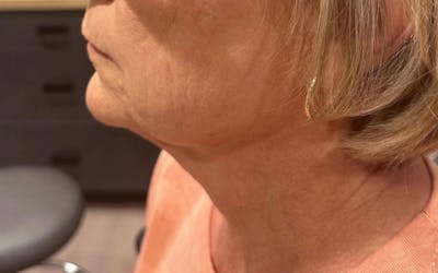 Morpheus8 Gallery Before & After Gallery - Patient 930130 - Image 2