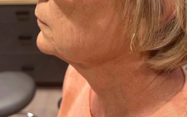 Morpheus8 Gallery Before & After Gallery - Patient 930130 - Image 2