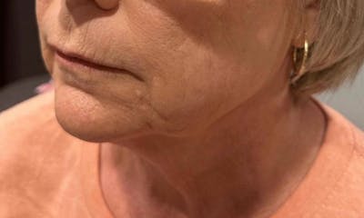 Morpheus8 Gallery Before & After Gallery - Patient 225128 - Image 2