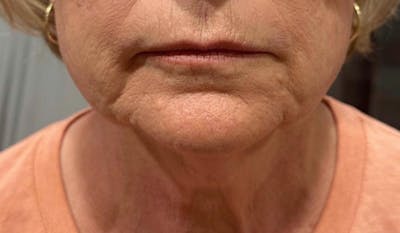 Morpheus8 Gallery Before & After Gallery - Patient 381000 - Image 2