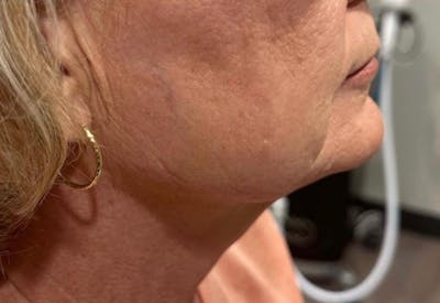 Morpheus8 Gallery Before & After Gallery - Patient 914206 - Image 2