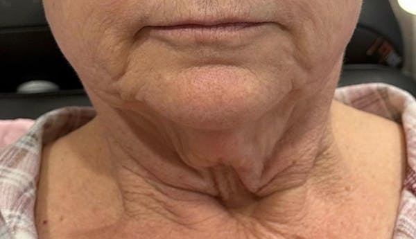 Morpheus8 Gallery Before & After Gallery - Patient 381000 - Image 1