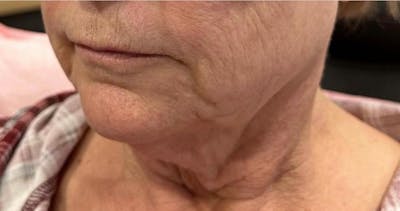 Morpheus8 Gallery Before & After Gallery - Patient 225128 - Image 1