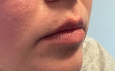Lip Filler Before & After Gallery - Patient 120559 - Image 1