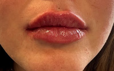 Lip Filler Before & After Gallery - Patient 120559 - Image 4