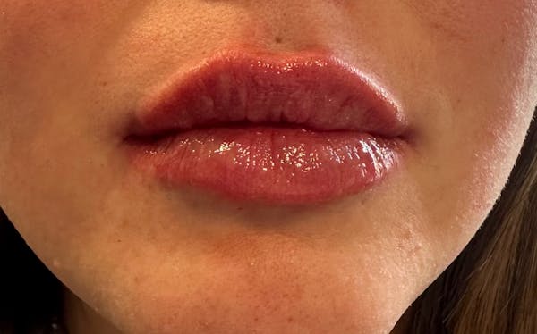 Lip Filler Before & After Gallery - Patient 120559 - Image 4