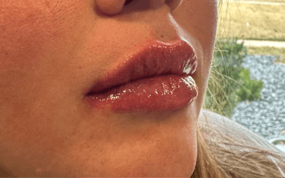 Lip Filler Before & After Gallery - Patient 120559 - Image 2