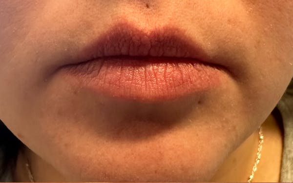 Lip Filler Before & After Gallery - Patient 120559 - Image 3