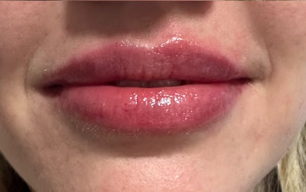 Lip Filler Before & After Gallery - Patient 110709 - Image 2