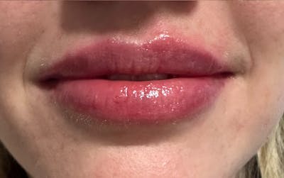 Lip Filler Before & After Gallery - Patient 110709 - Image 2