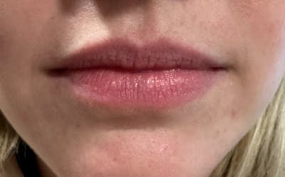 Lip Filler Before & After Gallery - Patient 110709 - Image 1