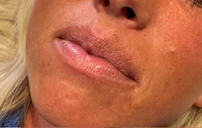 Lip Filler Before & After Gallery - Patient 312216 - Image 1