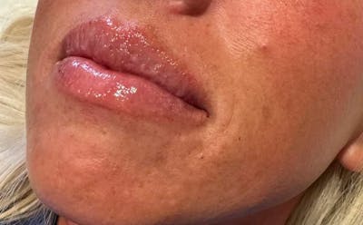 Lip Filler Before & After Gallery - Patient 312216 - Image 2