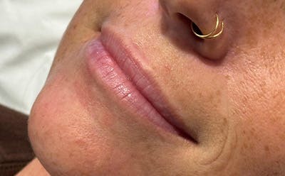 Lip Filler Before & After Gallery - Patient 266757 - Image 1