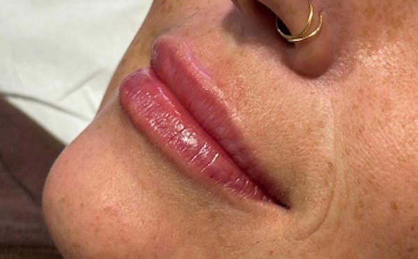 Lip Filler Before & After Gallery - Patient 266757 - Image 2