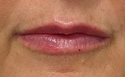 Lip Filler Before & After Gallery - Patient 278837 - Image 2