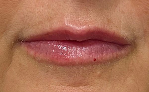 Lip Filler Before & After Gallery - Patient 278837 - Image 2
