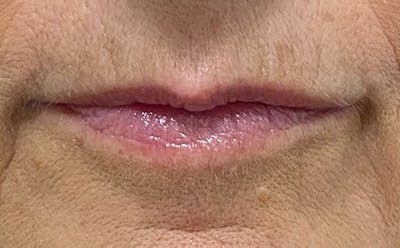 Lip Filler Before & After Gallery - Patient 278837 - Image 1