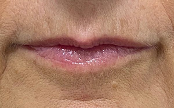 Lip Filler Before & After Gallery - Patient 278837 - Image 1