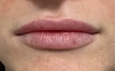 Lip Filler Before & After Gallery - Patient 222980 - Image 1