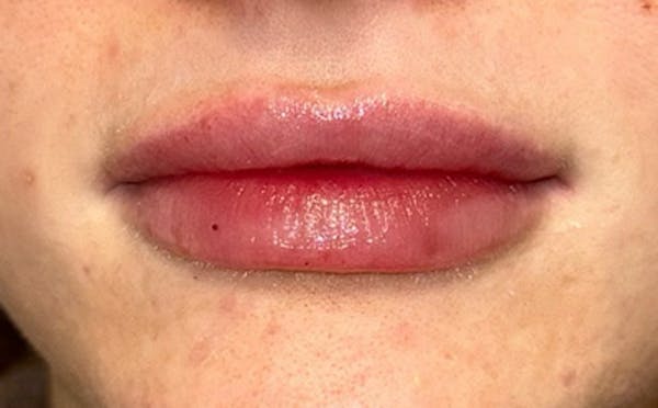 Lip Filler Before & After Gallery - Patient 222980 - Image 2