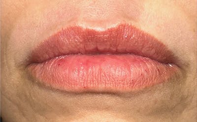 Lip Filler Before & After Gallery - Patient 232311 - Image 1