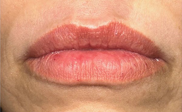 Lip Filler Before & After Gallery - Patient 232311 - Image 1