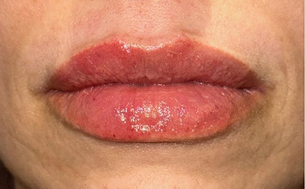 Lip Filler Before & After Gallery - Patient 232311 - Image 2