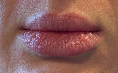 Lip Filler Before & After Gallery - Patient 420531 - Image 1