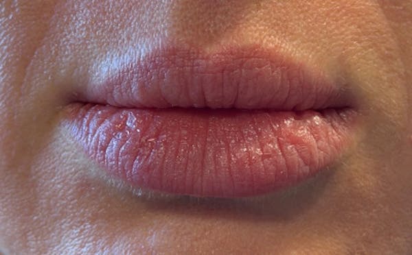Lip Filler Before & After Gallery - Patient 420531 - Image 1